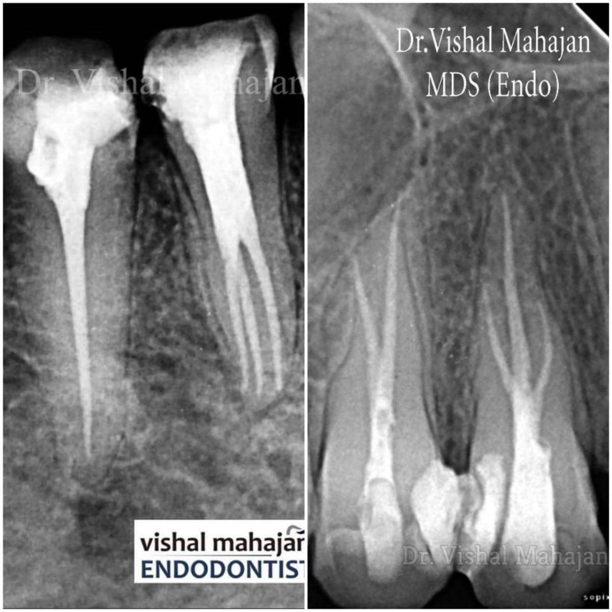 Root Canal Treatment