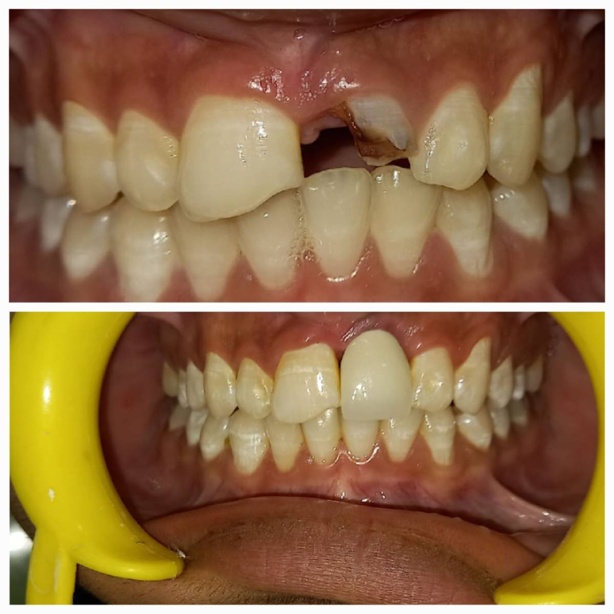 Smile Designing
